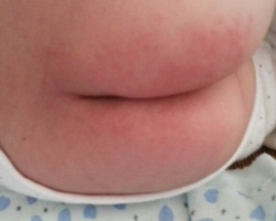 寶寶紙尿褲過敏怎么辦