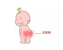 紙尿褲對寶寶皮膚有影響嗎？