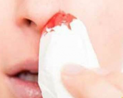 流鼻血的時(shí)候，別再傻傻地用衛(wèi)生紙堵鼻子了！